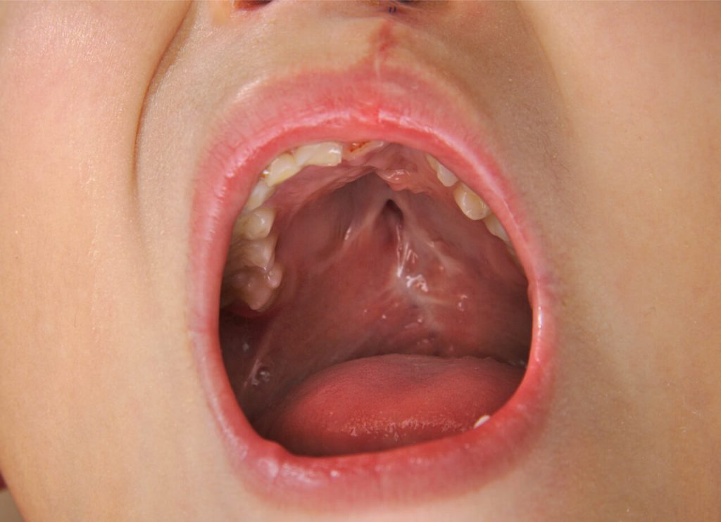 Is cleft palate genetic?