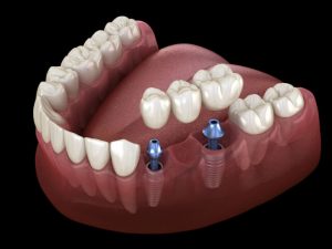 dental bridge procedures