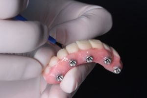 Determining The Cost Of All On 4 Dental Implants