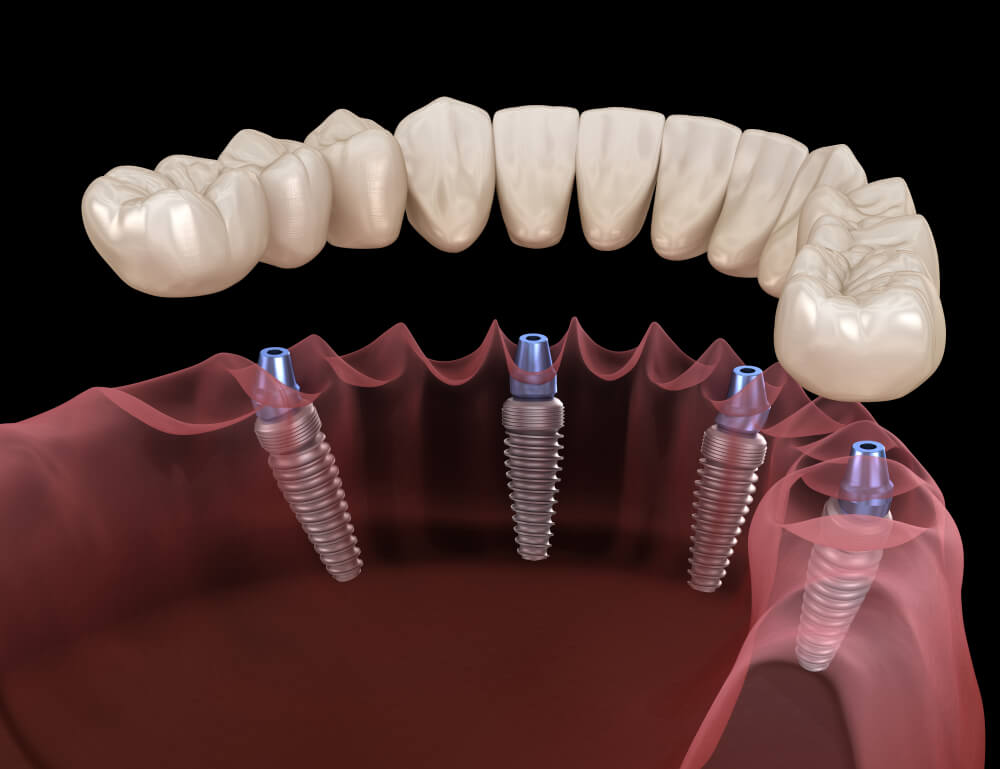 The Average Cost Of All On 4 Dental Implants