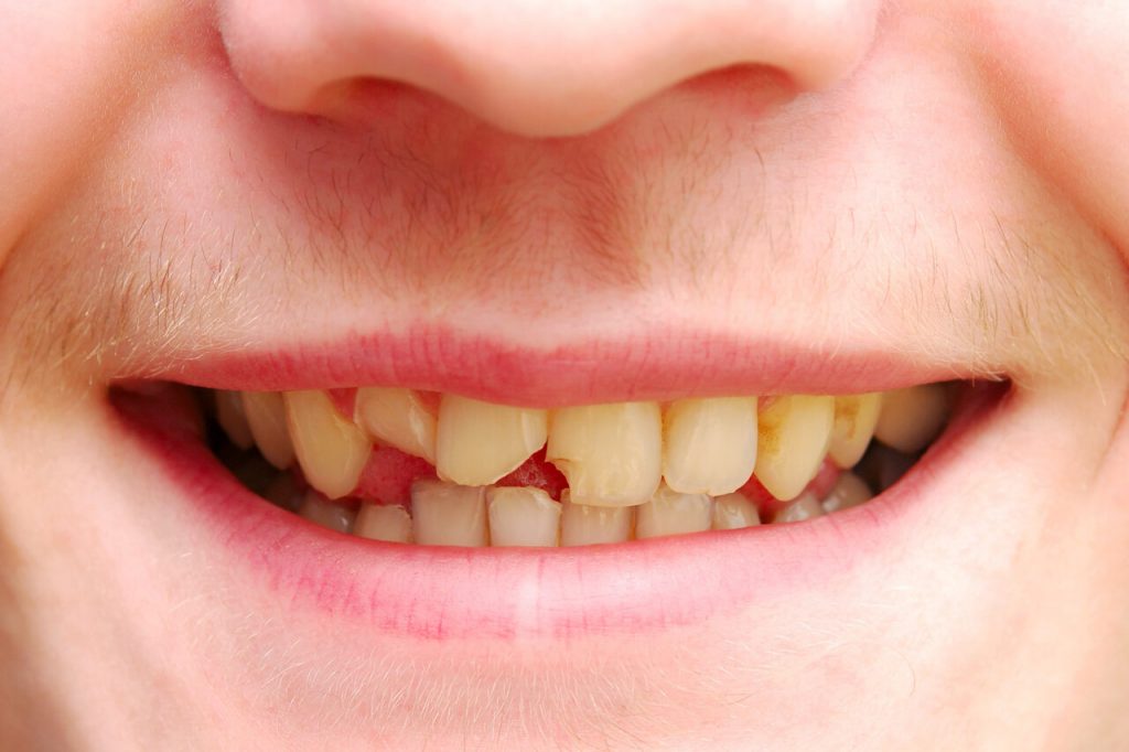What Happens if A Broken Tooth Goes Untreated? Complications and Remedy