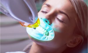 woman laser teeth whitening