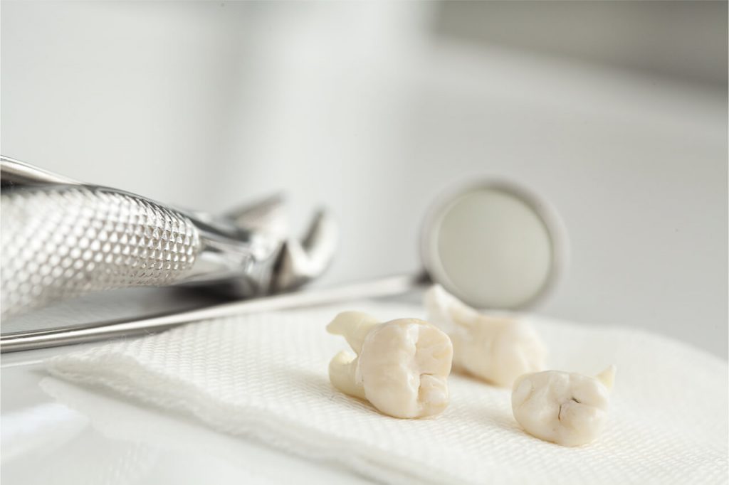 Molar Removal: Procedure and Aftercare