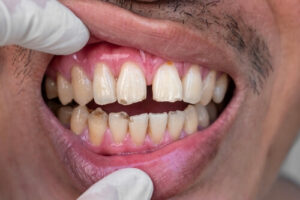treat receding gums